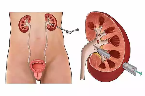 kidney-stones-symptoms-causes-types-and-treatment-tp-09